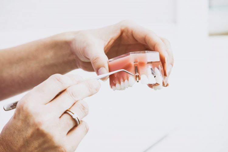 Anbringung eines Implantats an einem Zahnmodell Gebiss