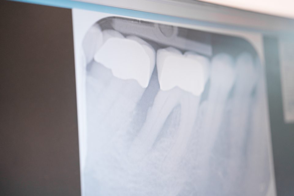 Röntgenbild von Zahnfleisch vor Parodontologie